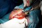 Mandibular reconstruction with hand drill