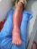 Cellulitis